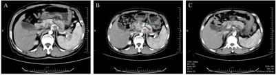 Case Report: Partial response to single-agent pembrolizumab in a chemotherapy-resistant metastatic pancreatic cancer patient with a high tumor mutation burden